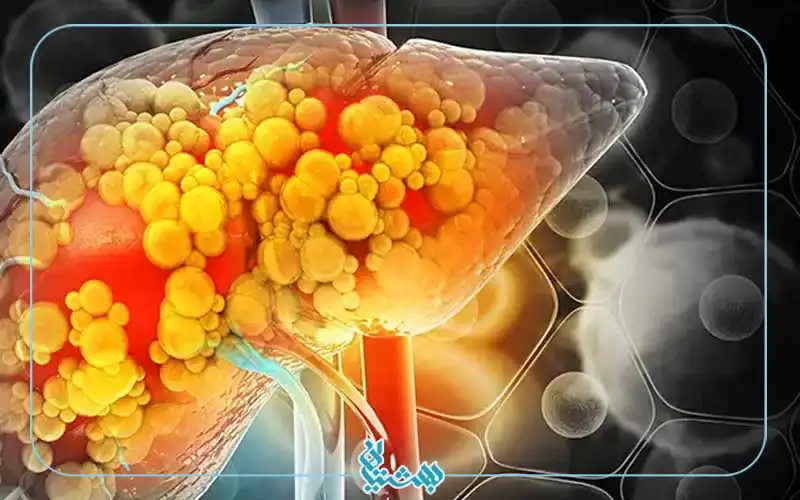 کبد-چرب2