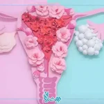 سندرم تخمدان پلی کیستیک