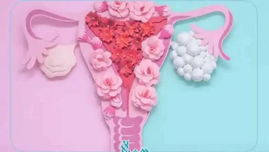 سندرم تخمدان پلی کیستیک