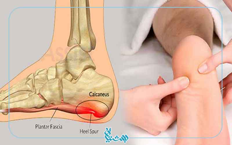 علایم خار پاشنه
