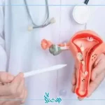 آندومتریوز