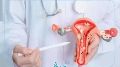 آندومتریوز