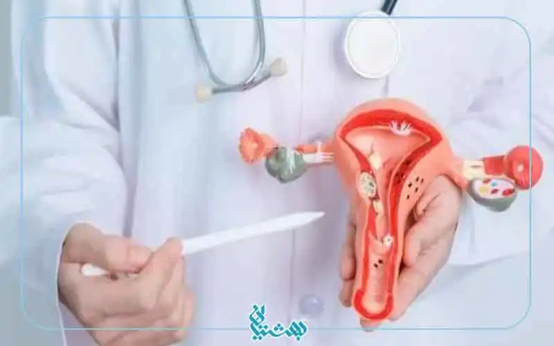 آندومتریوز