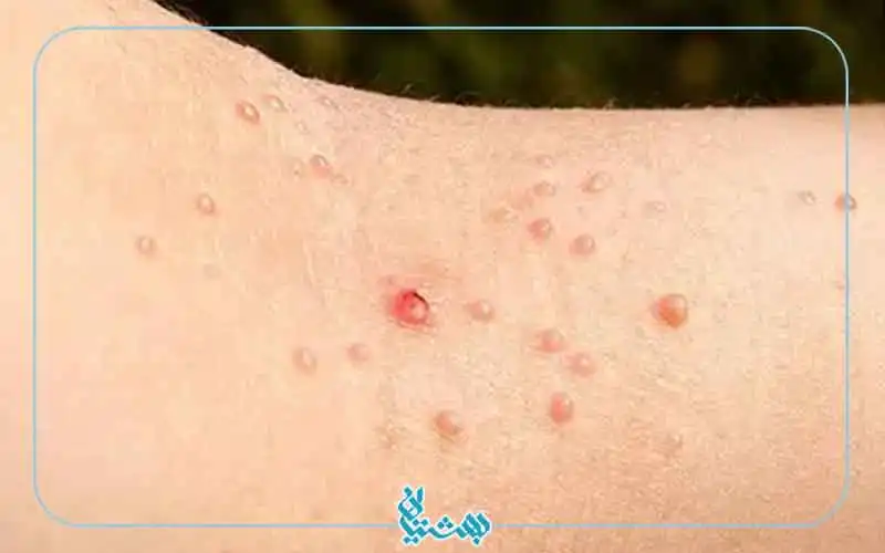 درمان زگیل پوستی