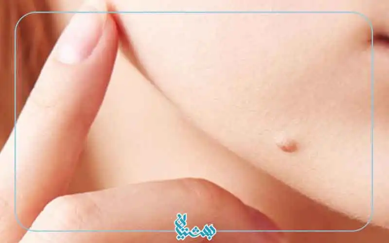 درمان خانگی زگیل پوستی