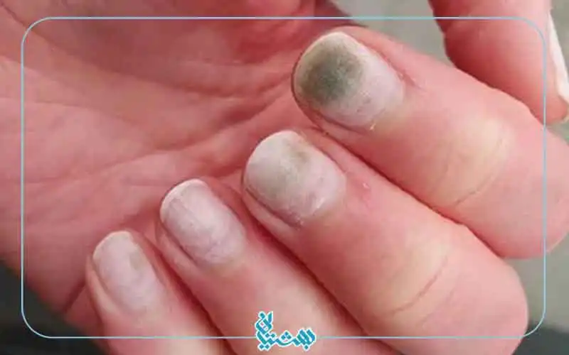 عوارض قارچ ناخن 