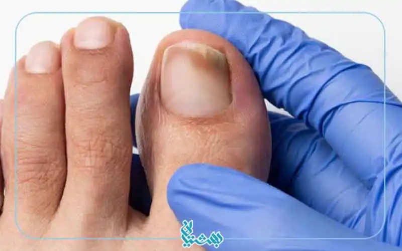 درمان قارچ ناخن 