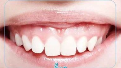 لبخند لثه ای