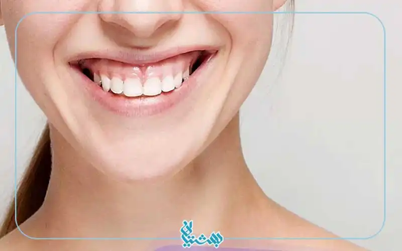 علت لبخند لثه ای