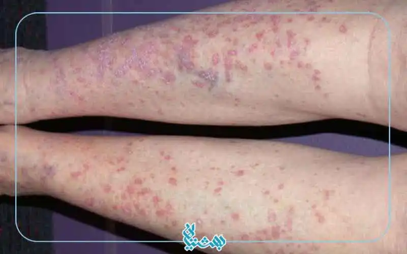 علائم لیکن پلان