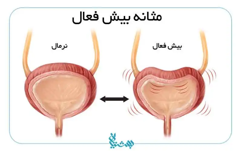 علایم مثانه بیش فعال