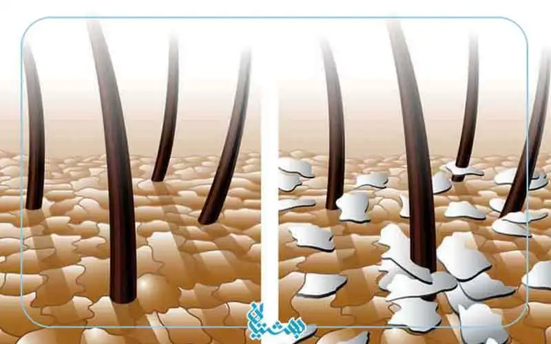 فرق شوره و پوسته سر