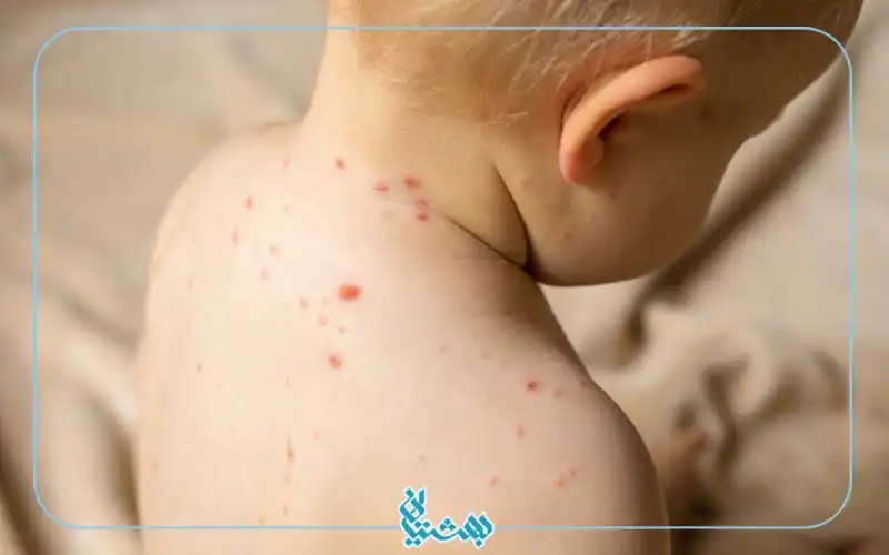 عوامل آبله مرغان