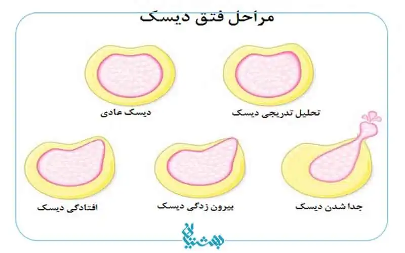  فتق دیسک گردن 