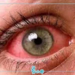 قرمزی چشم