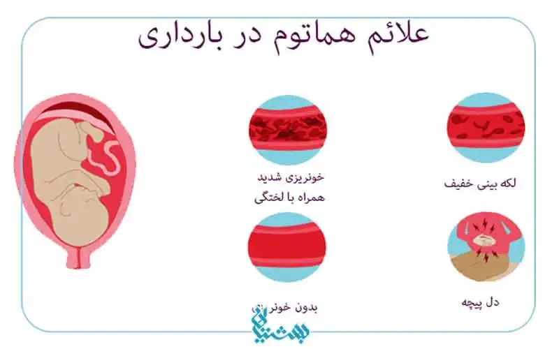 علائم هماتوم در بارداری